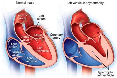 what is severe concentric left ventricular hypertrophy.